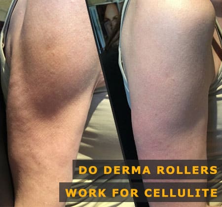 Featured Image Do Derma Rollers Work for Cellulite