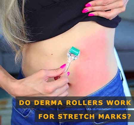 Featured Image of Do Derma Rollers Work for Stretch Marks