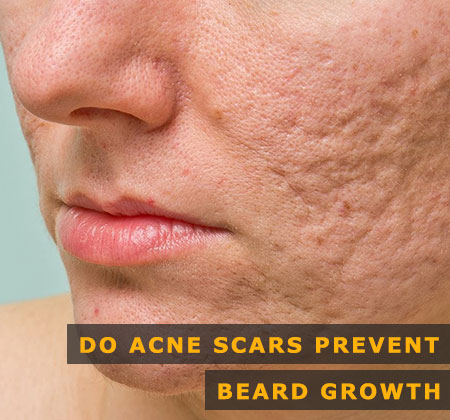 Featured Image of Do Acne Scars Prevent Beard Growth