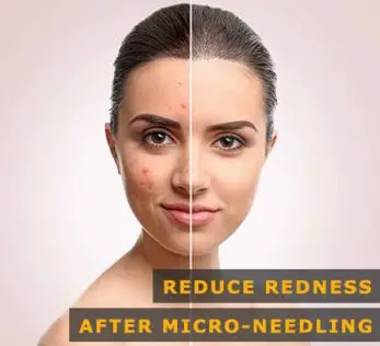 How to Reduce Redness After Micro-Needling