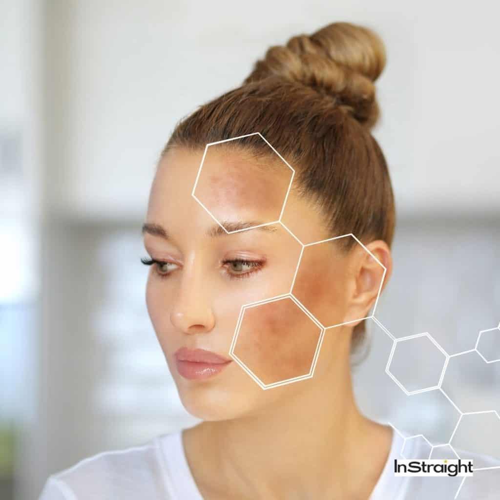 lady experiencing hyperpigmentation, one of the Side Effects of der
