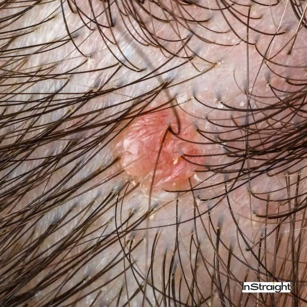 red bumps on the scalp