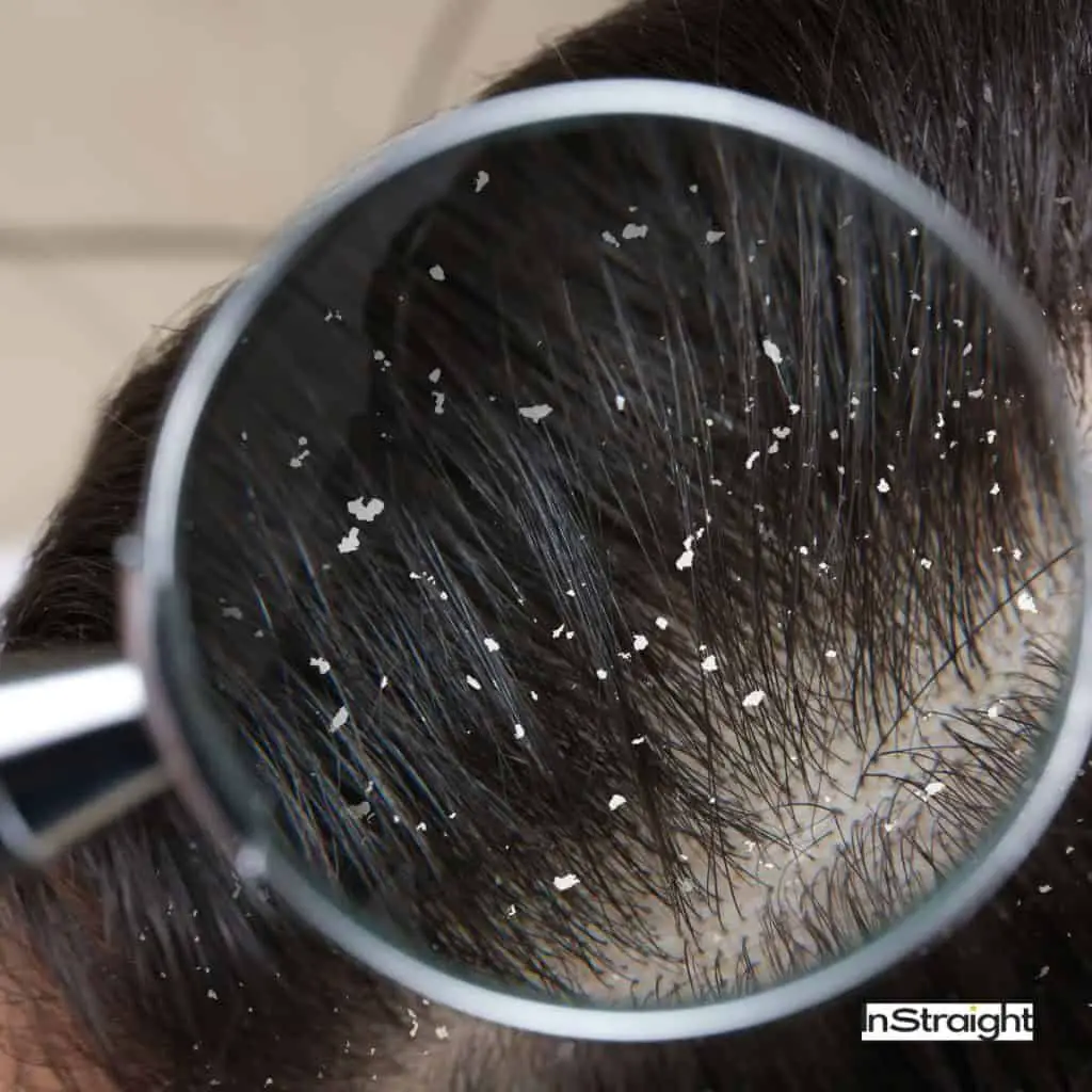 Dandruff on hair under title How Do I Know If My Scalp Is Damaged?